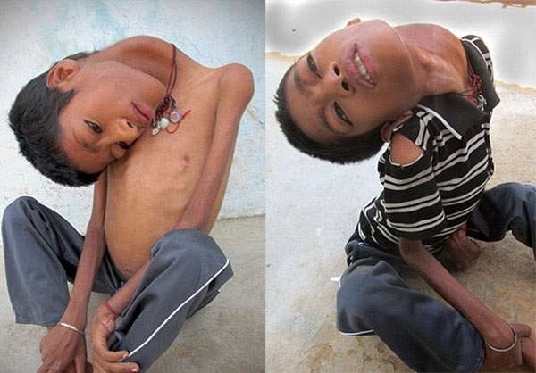 جراحی پسرک هندی با ۱۸۰ درجه وارونگی گردن (تصویر)