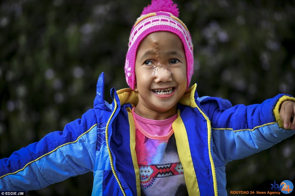 عارضه نادر روی صورت دختر چهارساله (تصاویر)