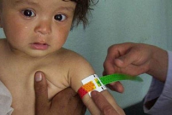 شناسایی ۲۰۱۸ کودک مبتلا به سوءتغذیه در چهارمحال و بختیاری