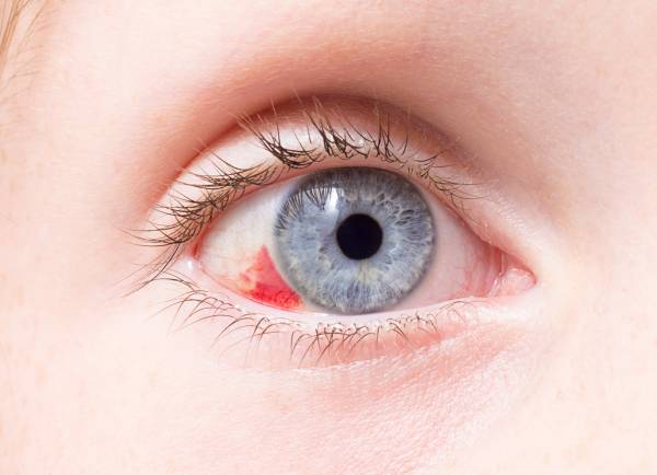 لکه قرمز داخل چشم به چه معناست؟