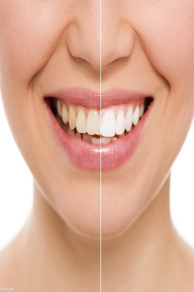 علت زردی دندان چیست و برای سفید کردن دندان‌ها چه کنیم؟