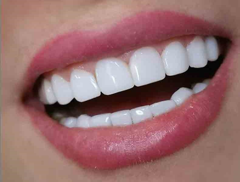 هرچیزی که باید در مورد کامپوزیت دندان بدانید