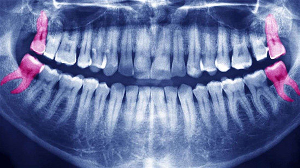 زمان مناسب کشیدن دندان عقل‌