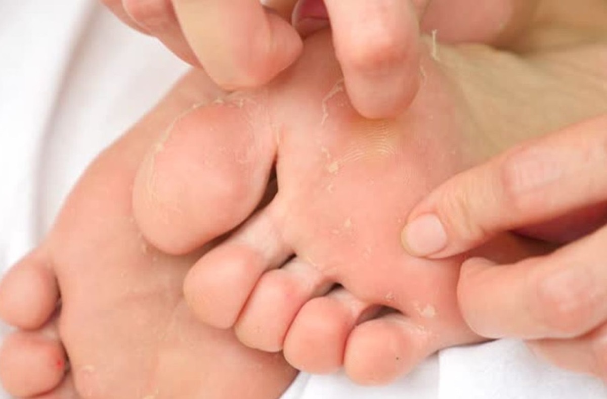 علت و درمان پوسته پوسته شدن کف پا