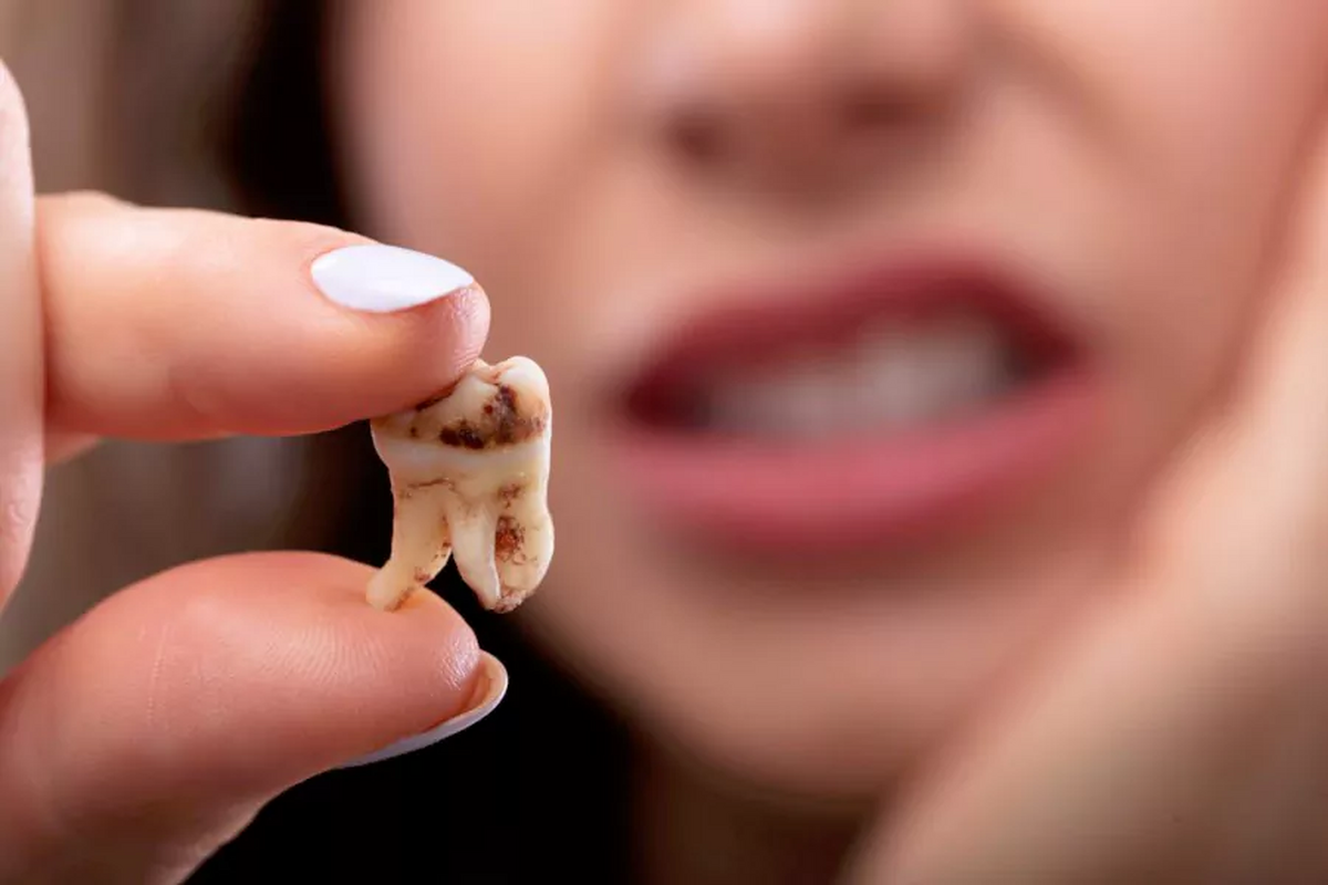 عوارض کشیدن دندان عقل: نکاتی که باید بدانید