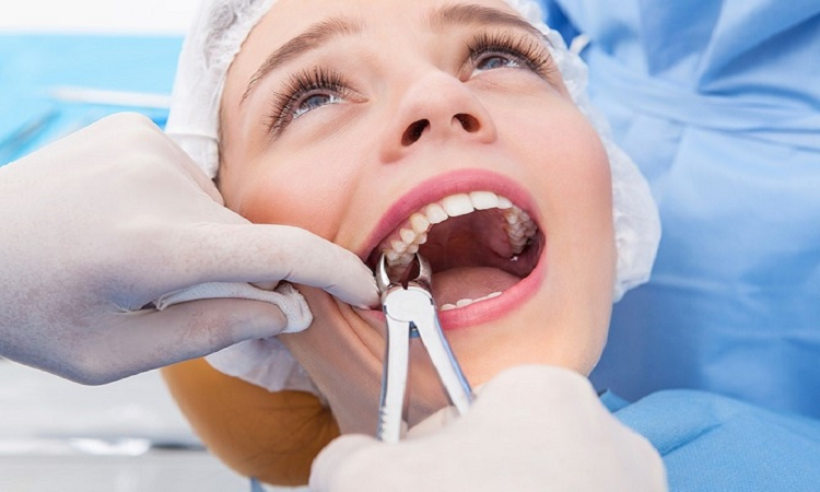 عوارض کشیدن دندان عقل: نکاتی که باید بدانید