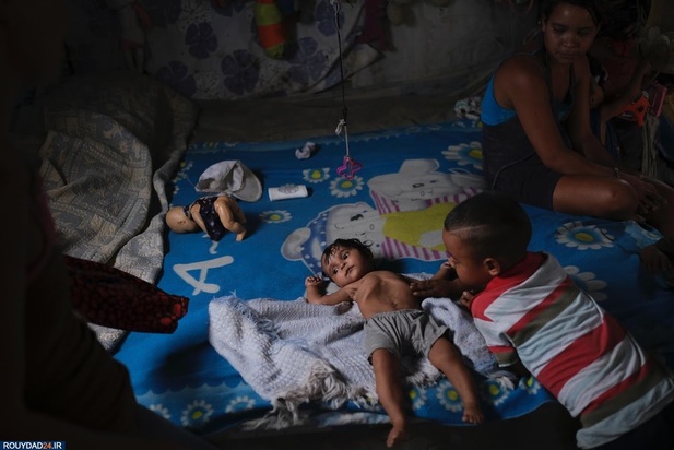 سوء تغذیه در کودکان ونزوئلا
